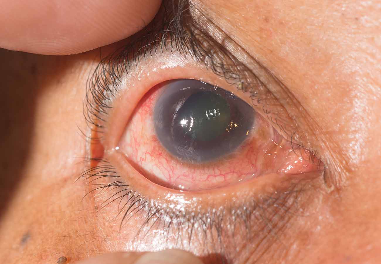 Glaucoma: La "enfermedad silenciosa" que lidera las causas de ceguera irreversible en Jalisco