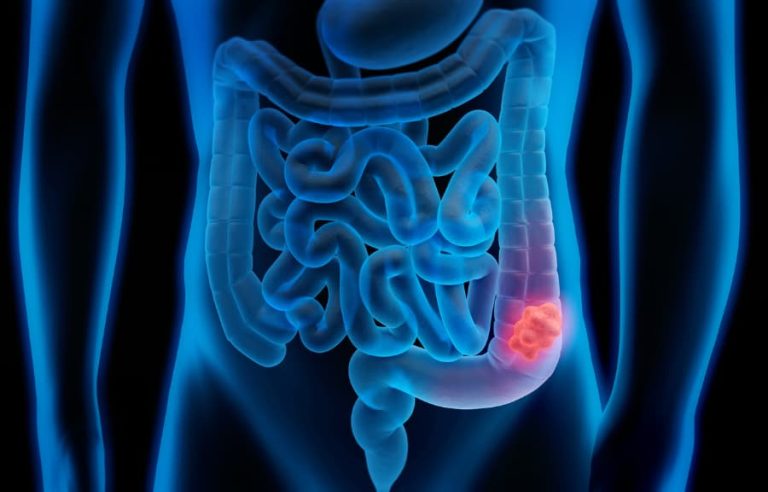 IMSS Jalisco insta a adultos de 50 a 74 años a realizarse pruebas gratuitas de cáncer de colon
